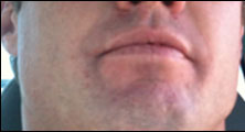 Manhattan Beach Bee Removal Guy Anthony right after being stung on the lip.